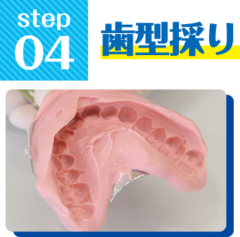 Step4.歯型採り