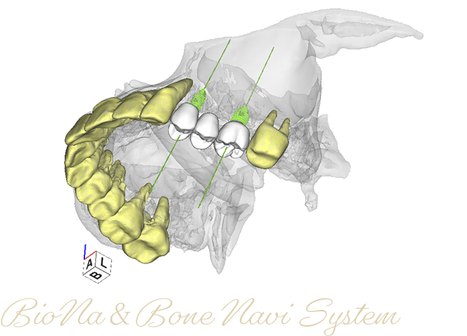 最新コンピュータシステム「BioNa」＆サージカルガイド「Bone Navi System」