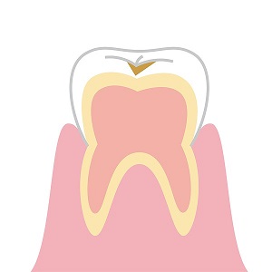 子供の虫歯の進行別治療法