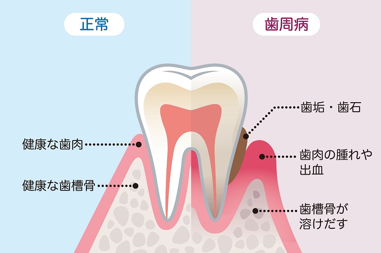 妊婦の歯周病