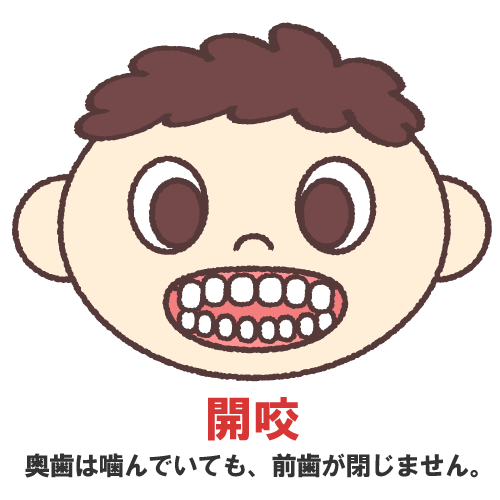 子供の前歯が噛み合っていない