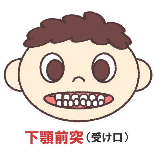 子供の受け口(しゃくれている)