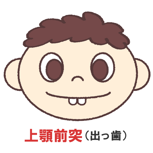 子供の出っ歯(歯が前に出ている)