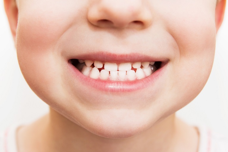 子供の受け口は自然に治ることもあるの？