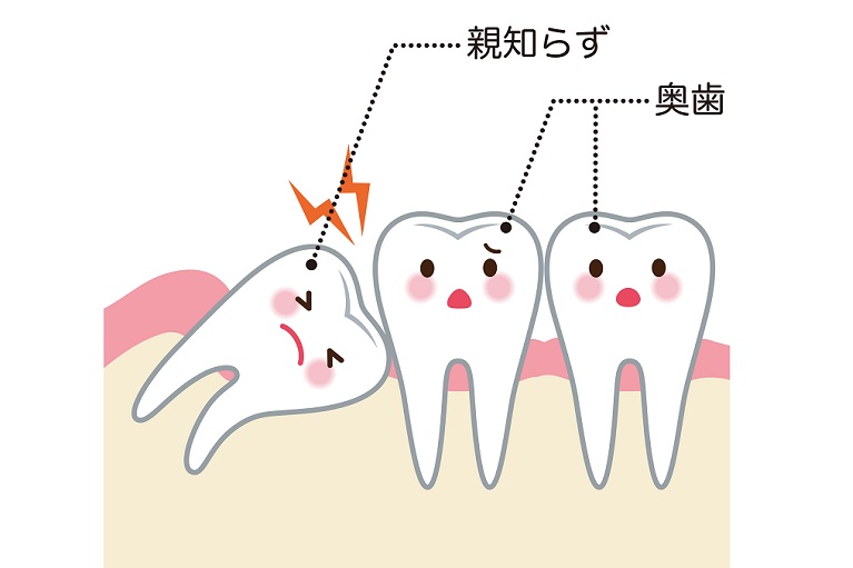 親知らずを放置しておくとどんなトラブルが起こるの？