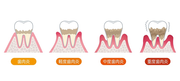 歯茎の腫れ・出血や膿がある場合は歯周病が原因