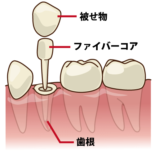 差し歯の構造って？どうなっているの？