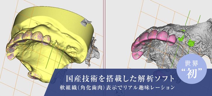 国産技術を搭載した解析ソフト 軟組織（角化歯肉）表示でリアル趣味レーション