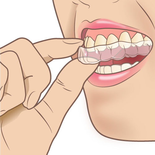 マウスピース矯正は痛い 歯が動いてる証拠 大阪の医療法人仁音会くすべ歯科