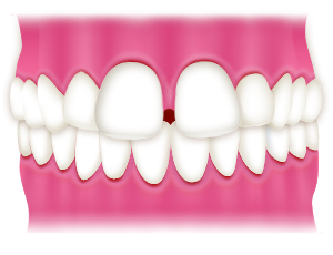 前歯のすきっ歯(隙間)