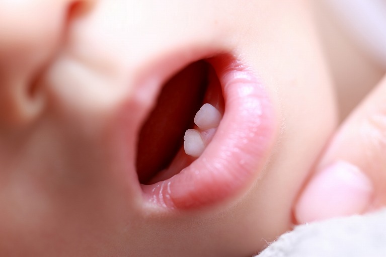 赤ちゃんの時から行う虫歯予防