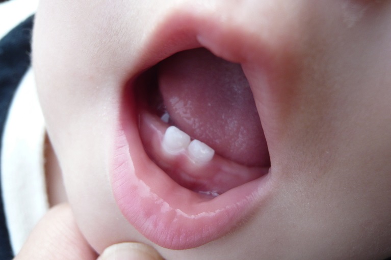 乳歯(赤ちゃんの歯)はいつ生えるの？