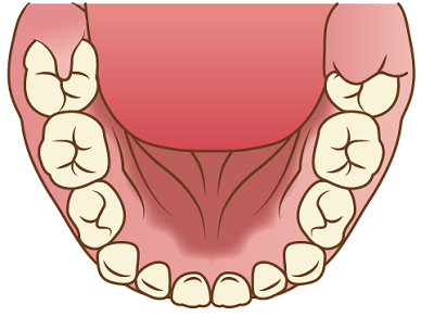 奥歯の歯茎がめくれている・被さっている「歯肉弁」