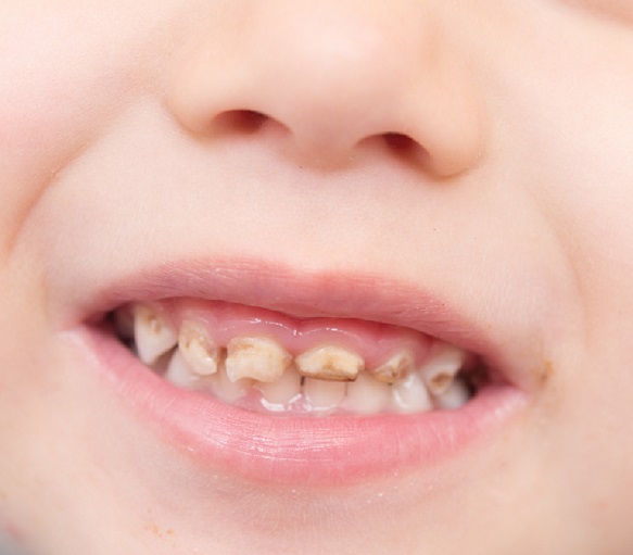 1～2歳の子供の前歯が虫歯になるのはなぜ？