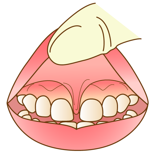 すきっ歯などの歯並びの乱れの原因になる