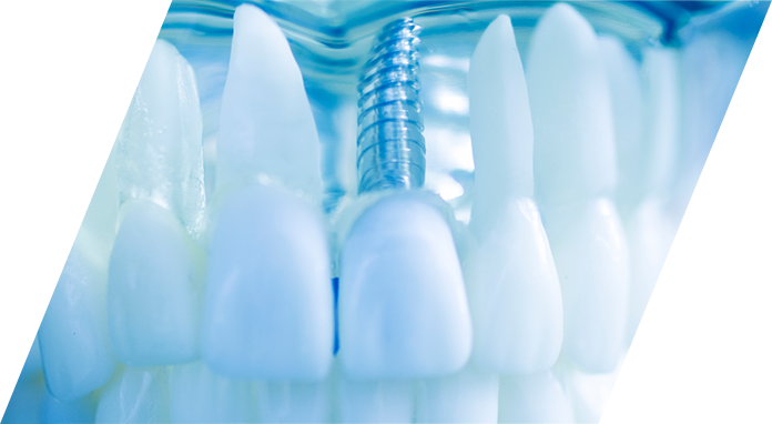インプラント治療とは第2の永久歯？？