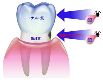 虫歯の原因