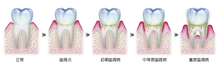歯周病の進行度と治療方法