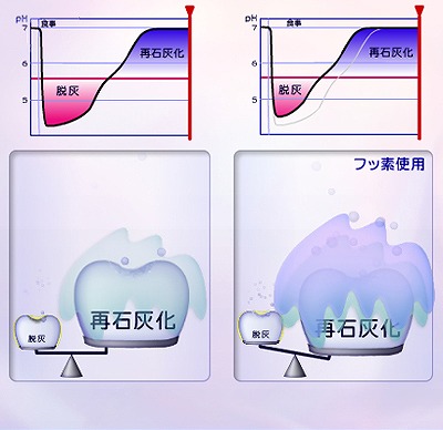 フッ素塗布