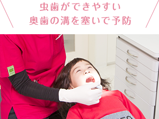 虫歯ができやすい奥歯の溝を塞いで予防